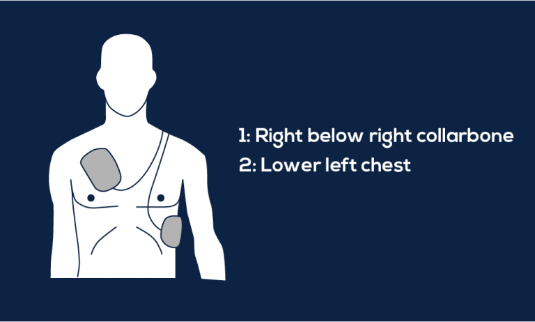 Guide To Aed Pad Placement Mdpro Usa 