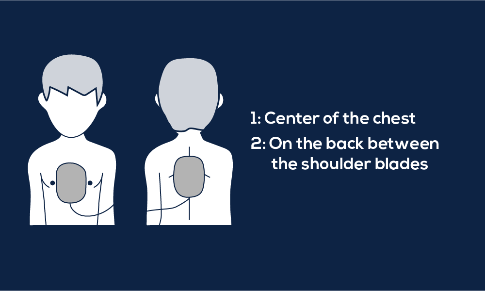 Automated External Defibrillator Pad Placement